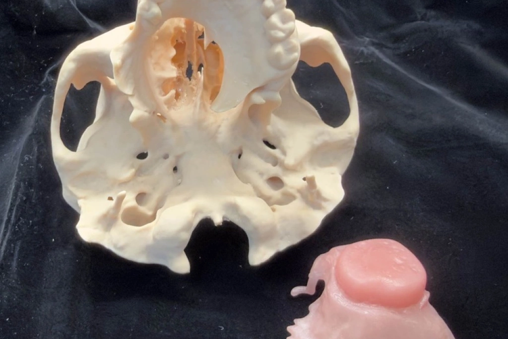 口鼻穿通8年不敢出門　數位閉孔器助再嚐聚餐滋味