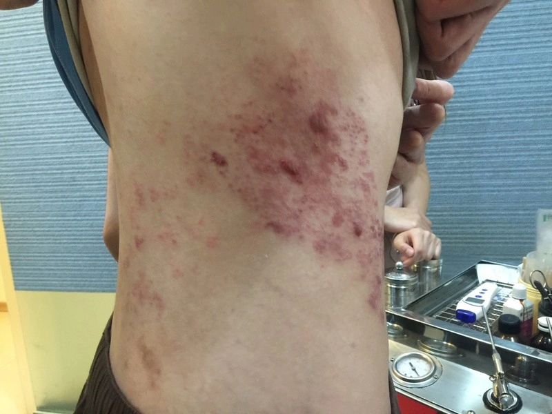 台中男尿不出來伴隨雷擊般抽痛  確診帶狀皰疹