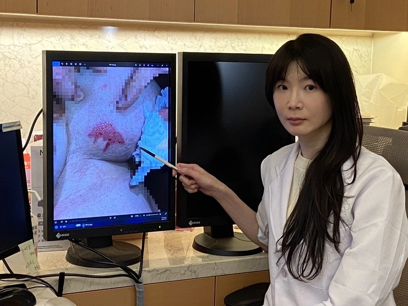 暖暖包放胸口9小時致脫皮　醫師：低溫燙傷