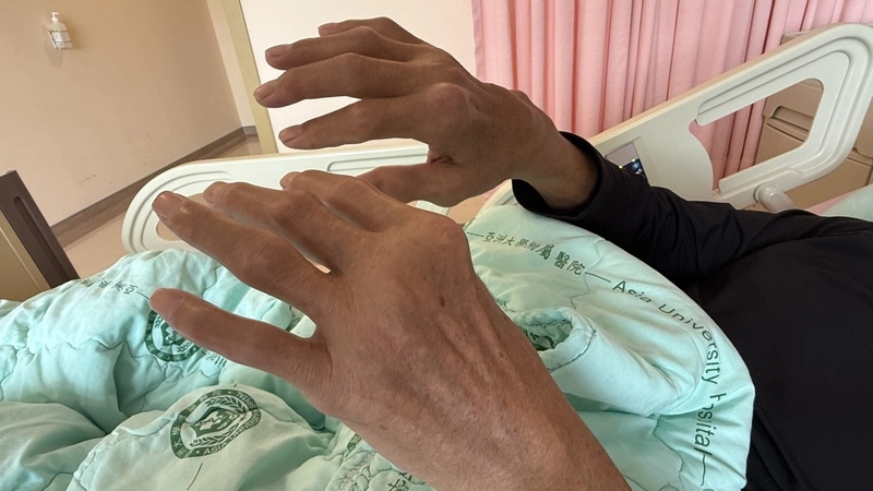 台中男痛風石如雞蛋大破裂 醫警告未控制飲食恐截肢