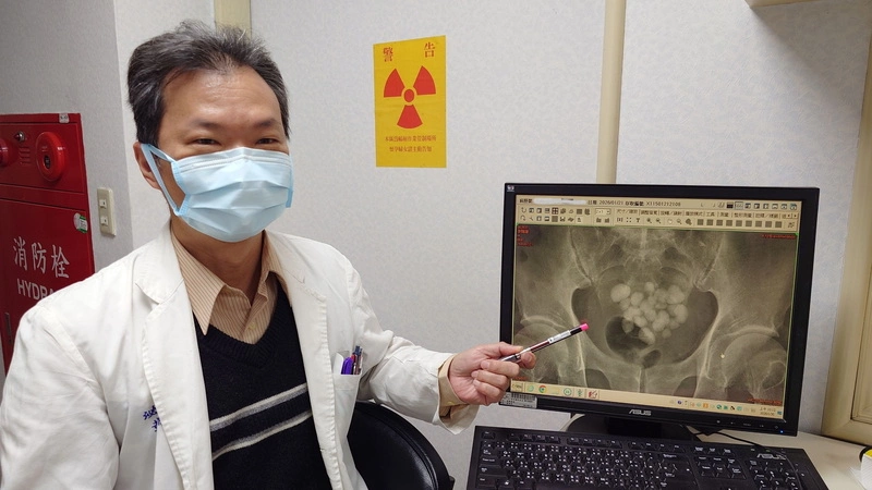 嘉義8旬翁排尿困難　手術取出24顆膀胱結石