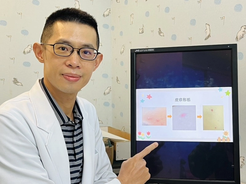 水痘不只出疹　醫師提醒傳染力極強