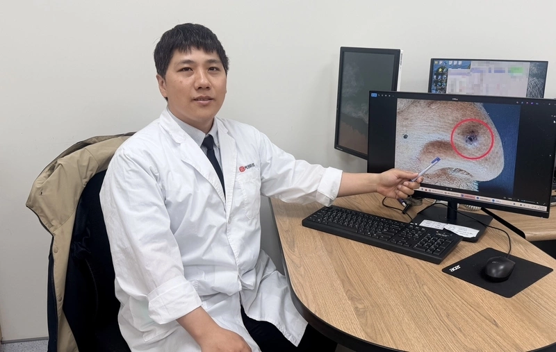 老翁鼻部出現突出病灶　檢查為基底細胞癌