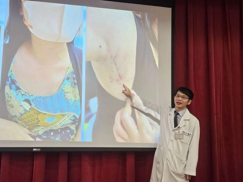 26歲患甲狀腺癌怕留疤　選腋下切口保外觀與嗓音