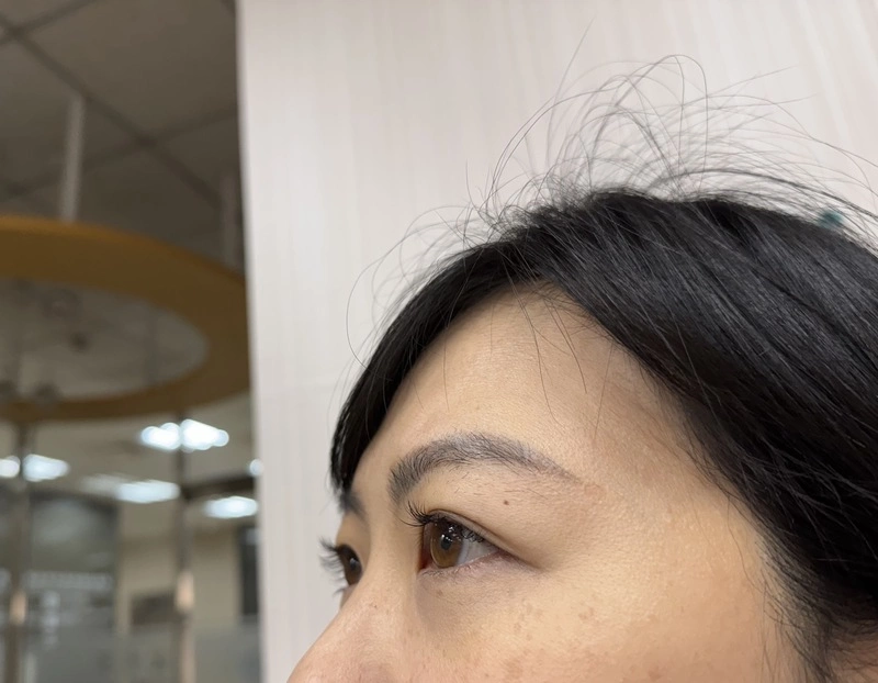 眼皮長黃色瘤暗藏心血管警訊　只靠醫美不夠